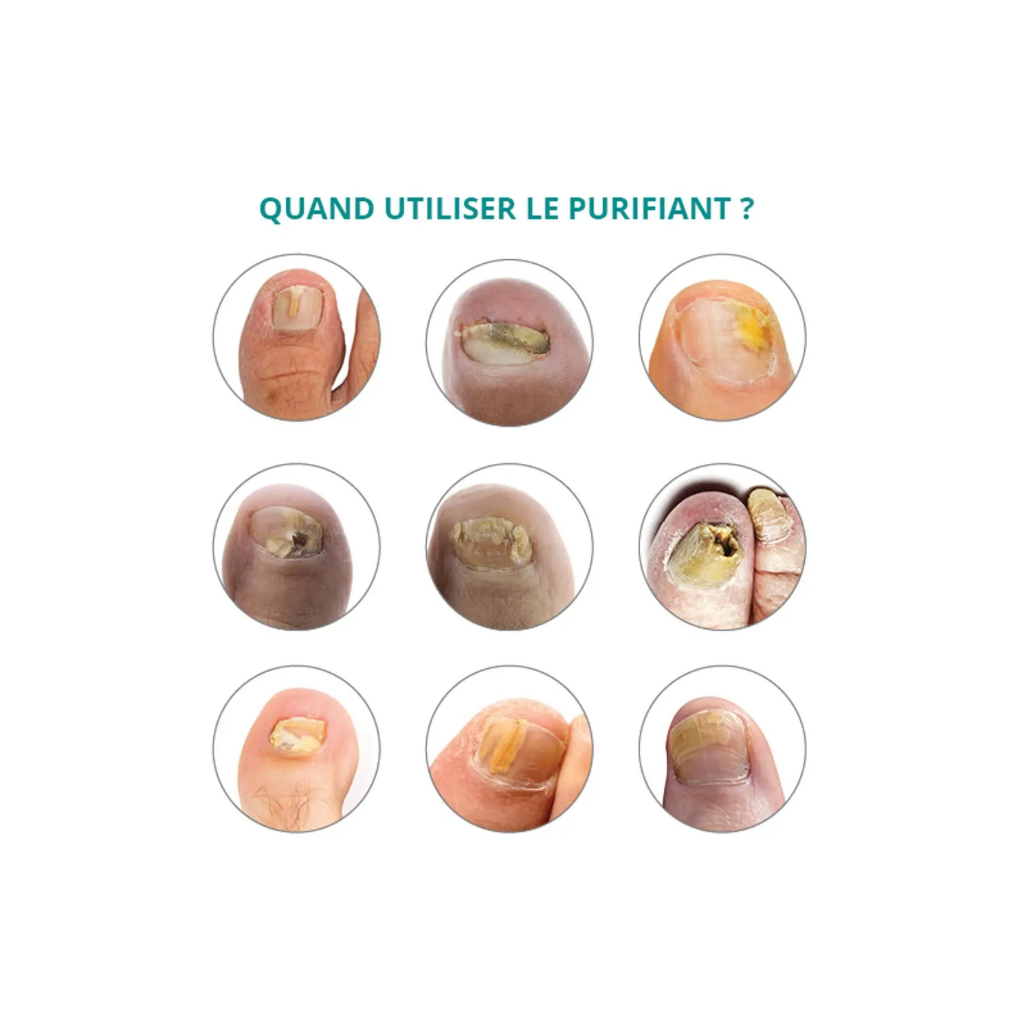 FUNGAL NAILS PURIFIANT